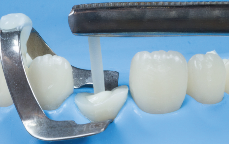 Desafios e Soluções para Dentes com Tratamento Endodôntico